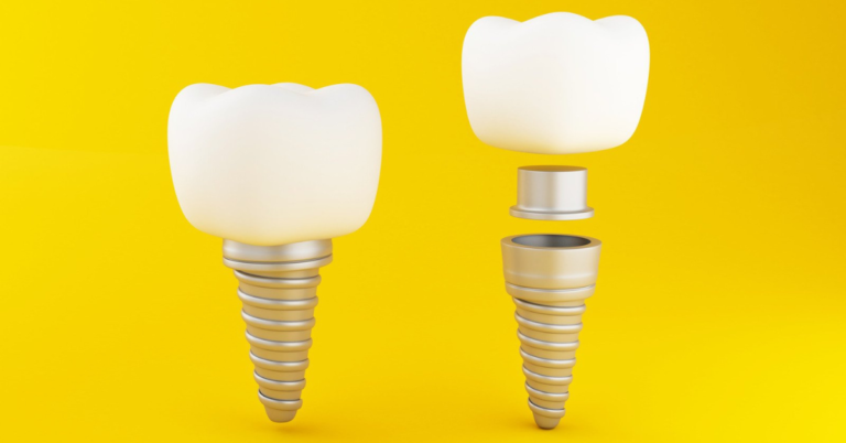 Can Dental Implants Be Used For Individuals With A Cleft Palate Or Other Congenital Conditions?