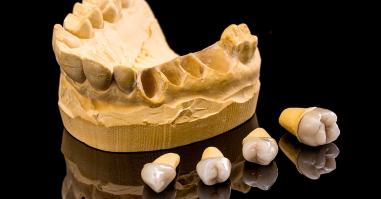 Can Dental Implants Be Used To Replace A Full Arch Of Missing Teeth?