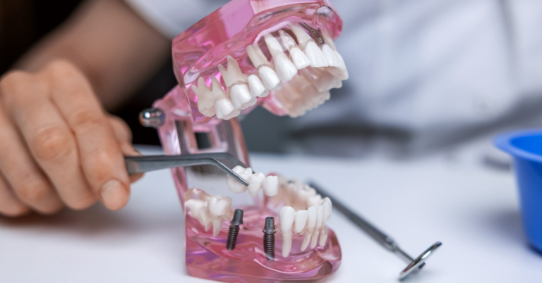 Can Dental Implants Replace Missing Teeth That Have Been Missing For A Long Time?