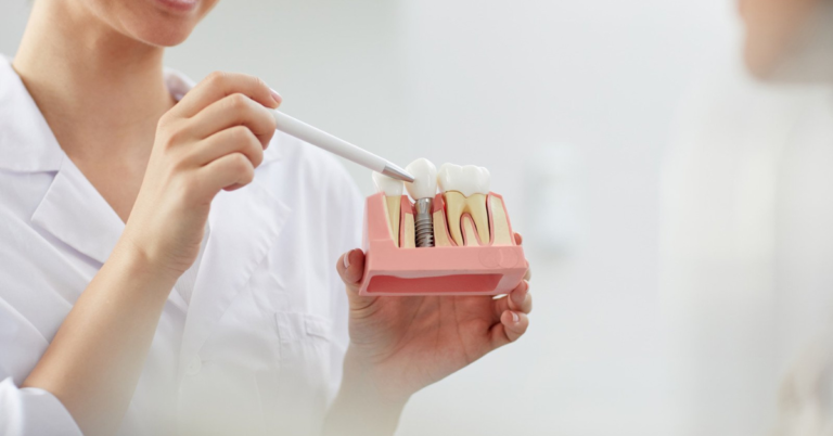 Will I Experience Any Changes In Taste Or Sensation After Getting Dental Implants?