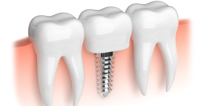 Are dental implants suitable for individuals with bruxism (teeth grinding) or clenching?