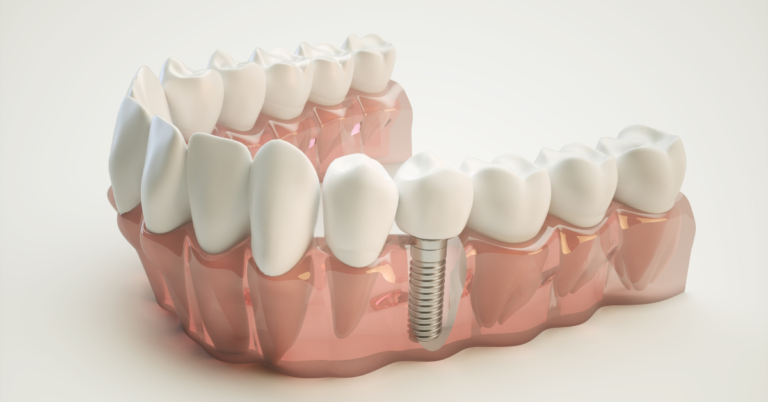 Can I get dental implants if I have a metal allergy?