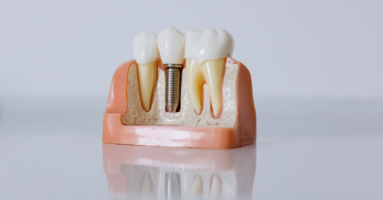 Can dental implants replace missing teeth in both the upper and lower jaws?