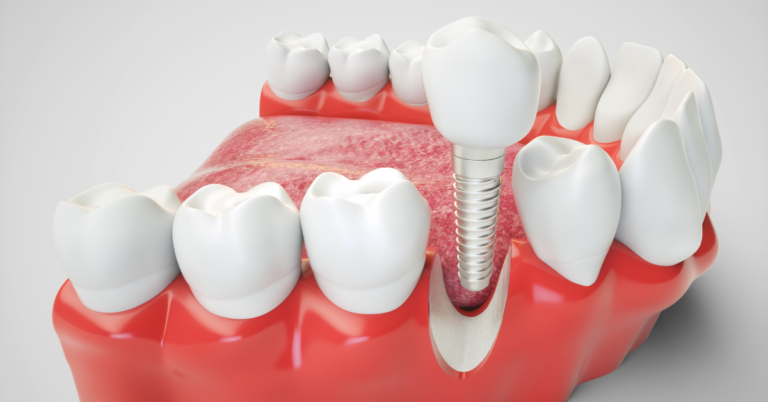 Can dental implants replace missing teeth in the front of the mouth?