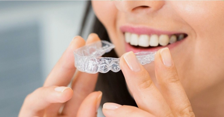 How long do I need to wear retainers after Invisalign treatment?