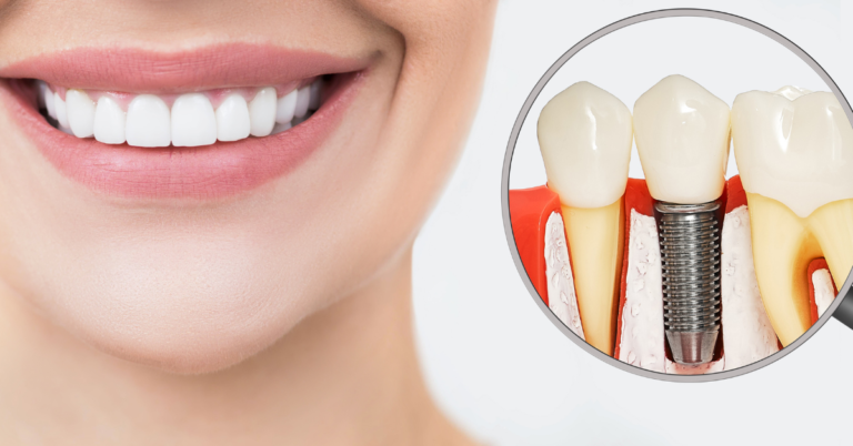 How long does the dental implant process take from start to finish?