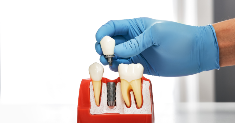 What is the difference between a dental implant and a dental bridge?